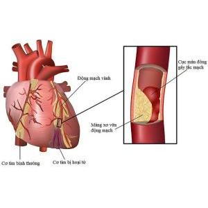 Nấm linh chi hỗ trợ điều trị bệnh tim mạch